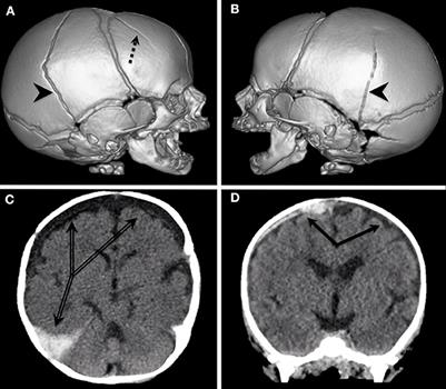 Advances and Future Directions of Diagnosis and Management of Pediatric Abusive Head Trauma: A Review of the Literature